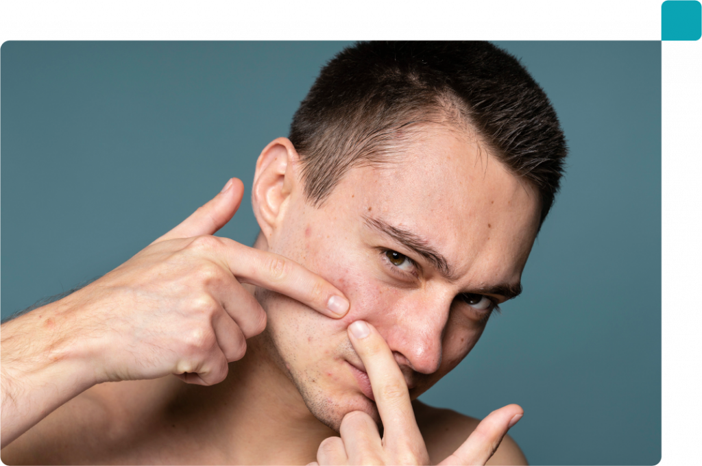 Acne Scars Best Aesthetic Clinic Malaysia Aesthetic Clinic Kuala Lumpur