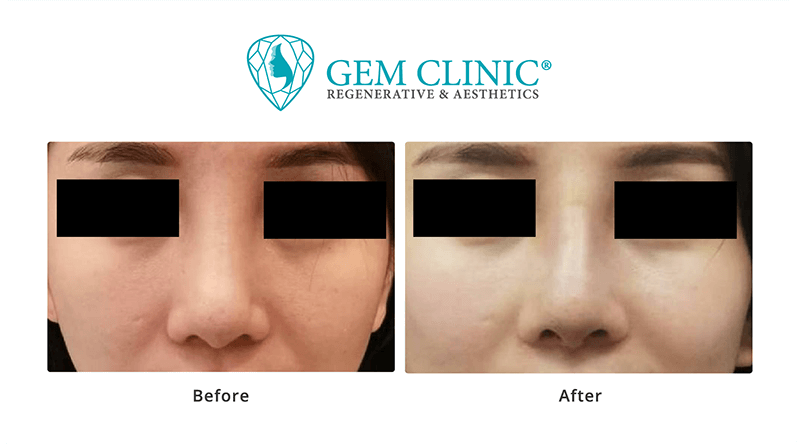 Rhinoplasty Malaysia - Nose Job Surgery Malaysia