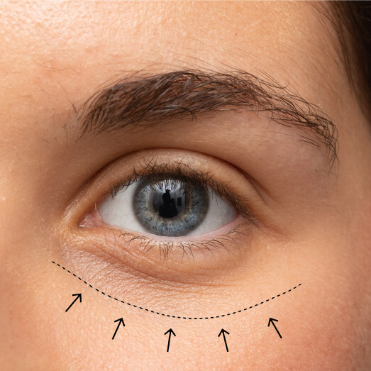Eye bag removal treatment in Malaysia