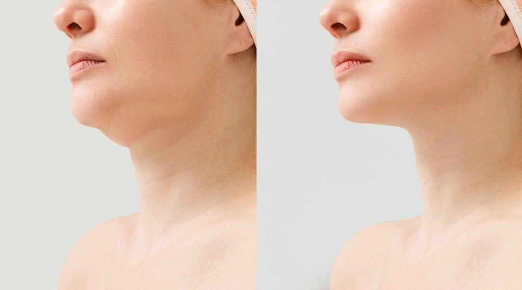 female-double-chin-before-after-correction-correction-chin-shape-liposuction-neck-result-procedure-clinic-aesthetic-medicine-1024x570.jpg