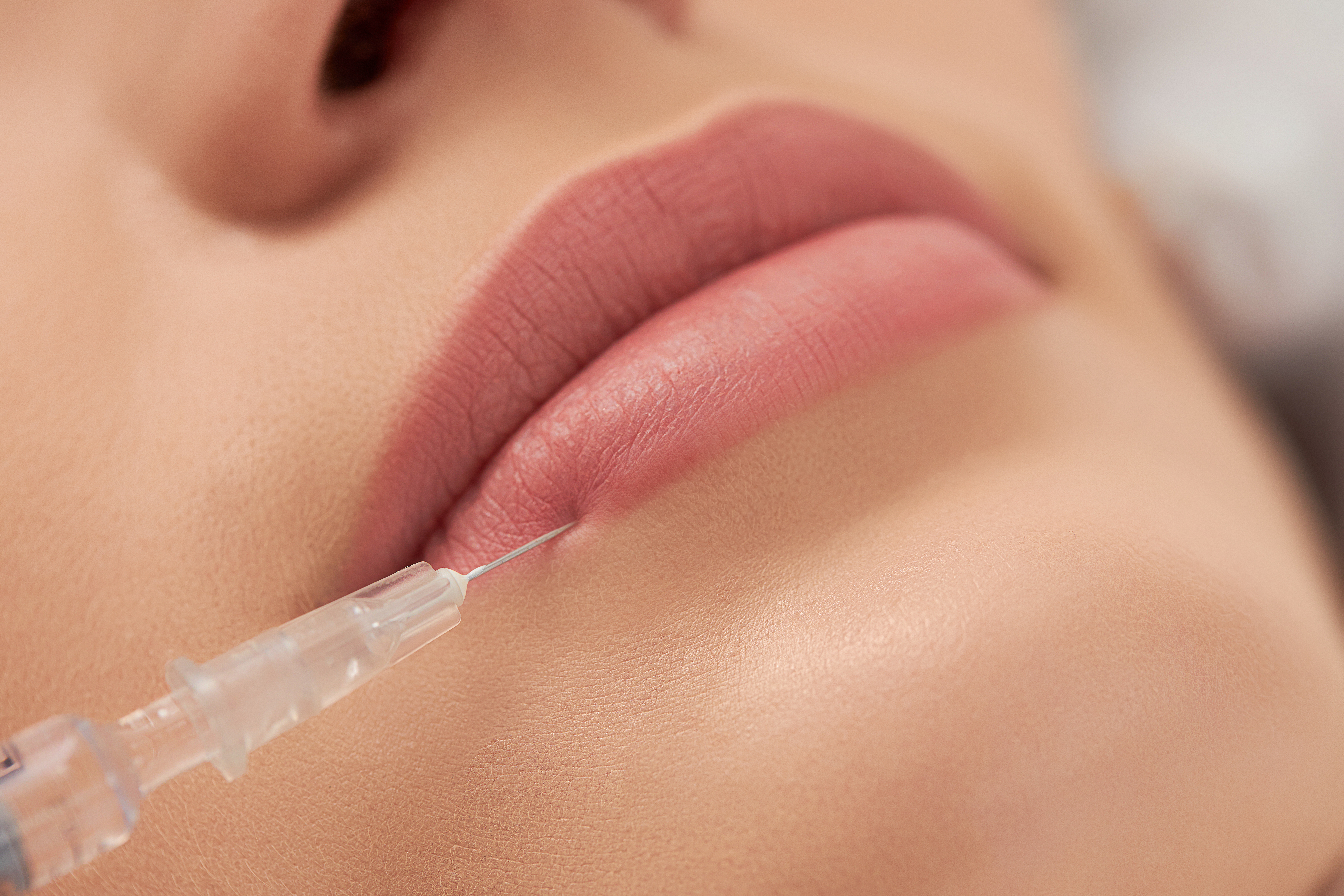 5 things to know before a lip filler treatment