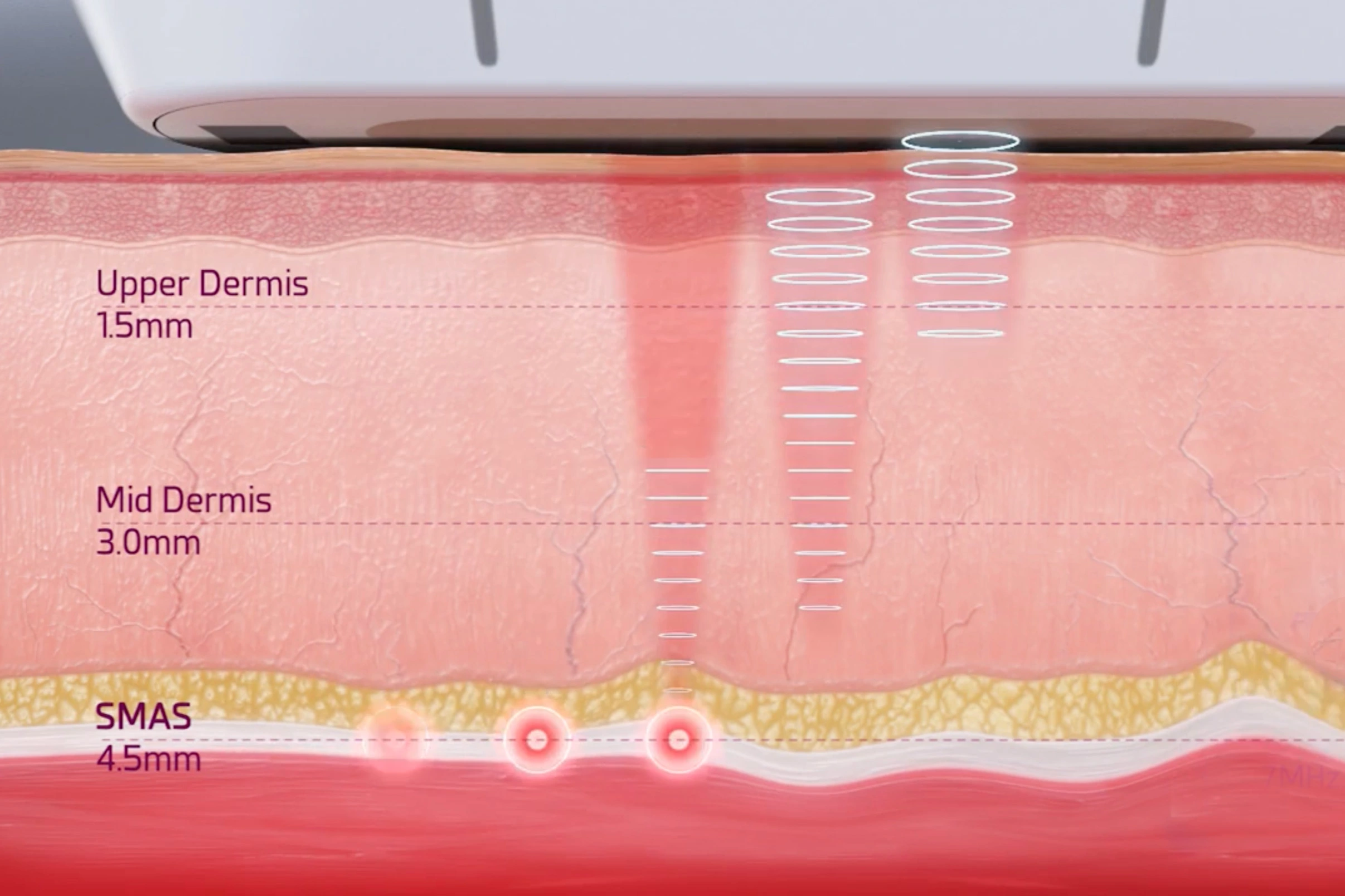 hifu 3 layers advanced technology