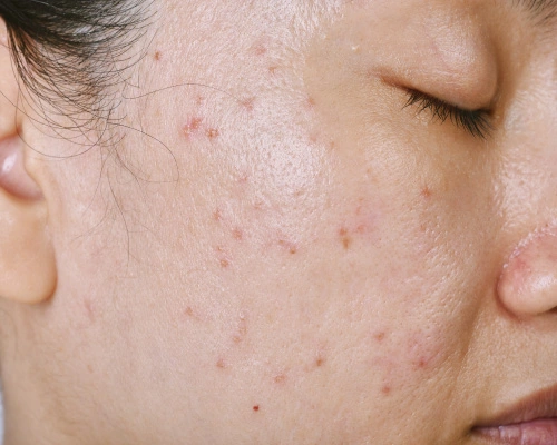 acne condition